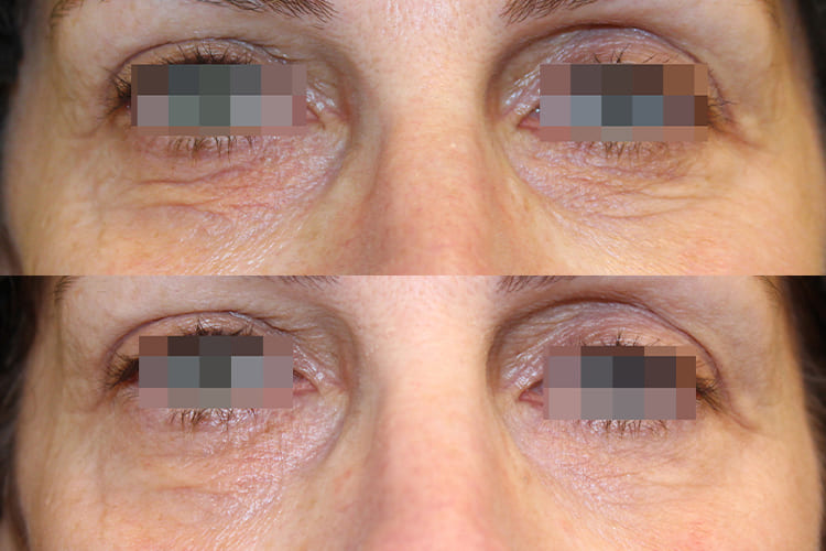 Opus-Before-After-Web-Hsu02-Post-txs