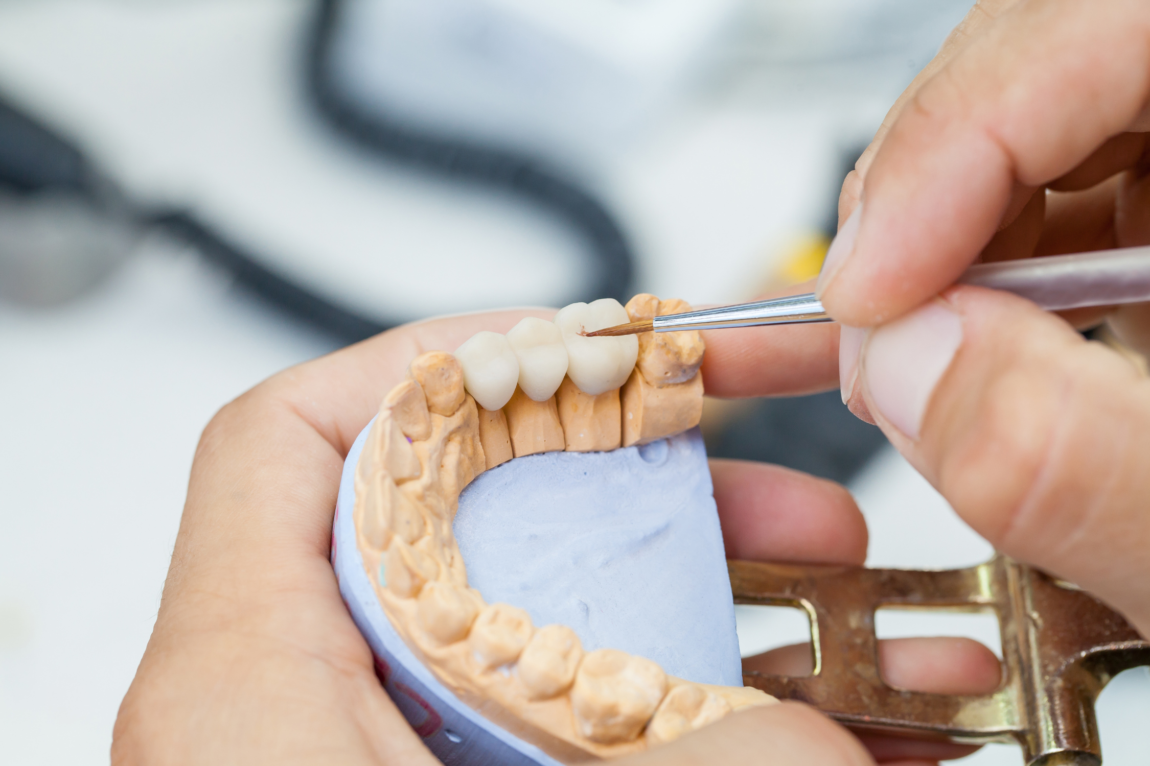 Dental bridge restoration at Georgetown Advanced Dentistry in Washington, DC