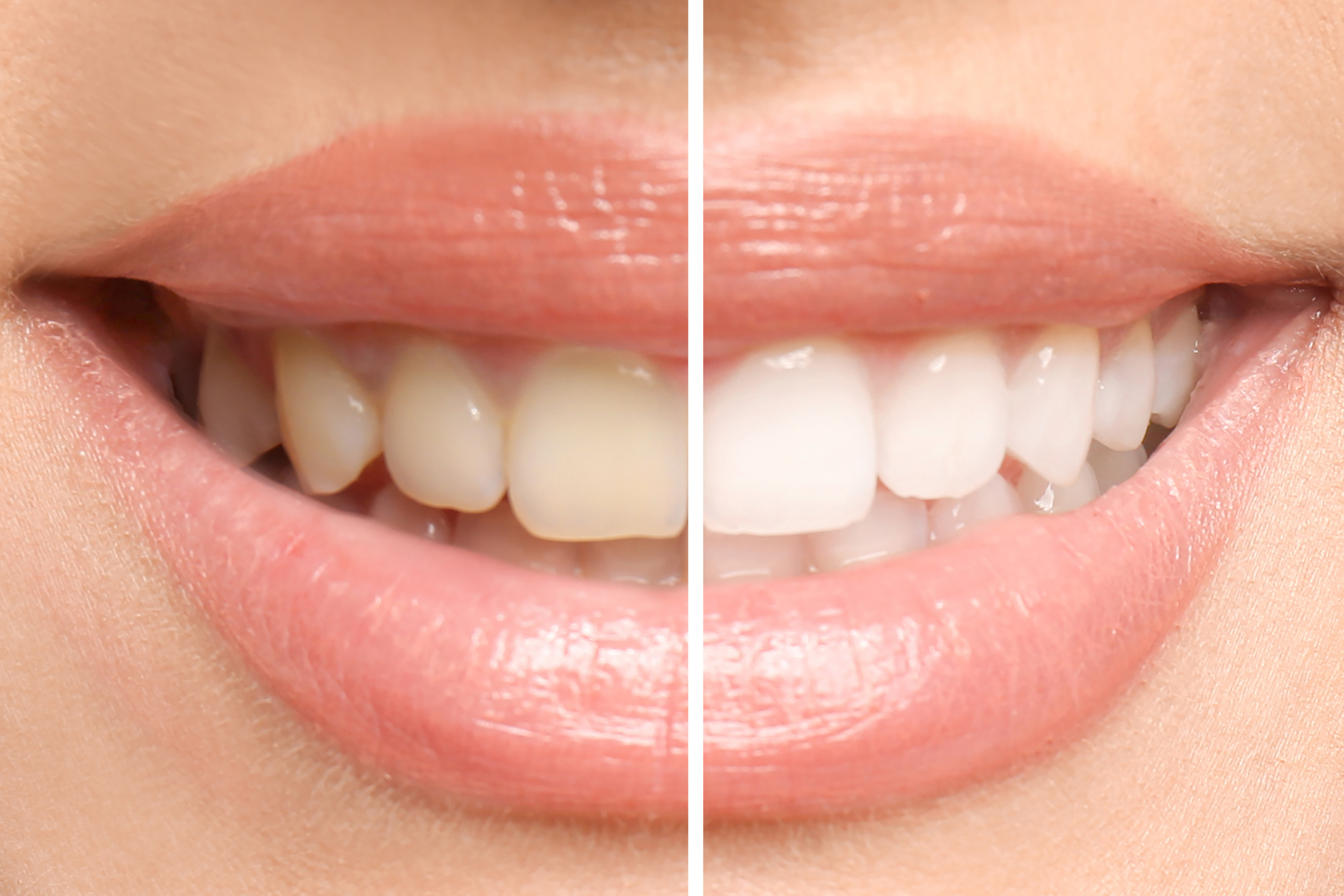 Before and after teeth whitening comparison at Georgetown Advanced Dentistry in Washington, DC